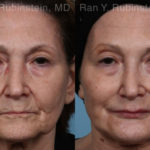 Dermal Fillers Before and After Photos in Montvale, NJ, Patient 20745