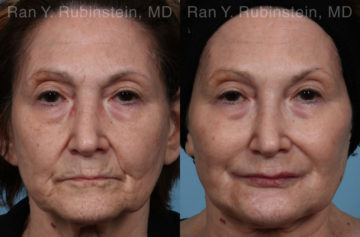 Dermal Fillers Before and After Photos in Montvale, NJ, Patient 20745