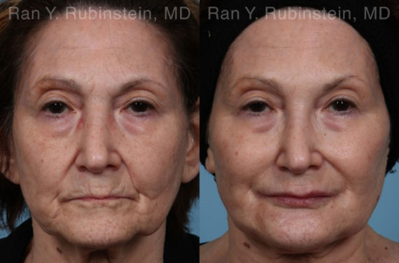 Dermal Fillers Before and After Photos in Montvale, NJ, Patient 20745