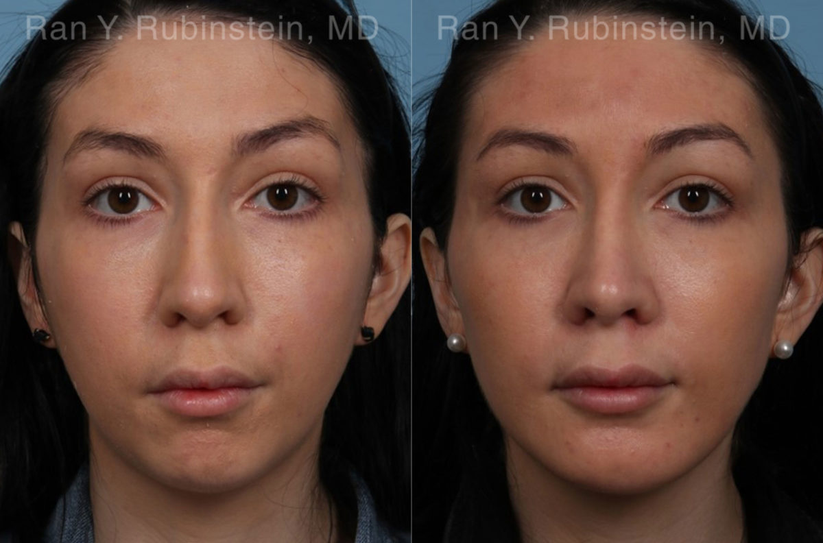 Chin Augmentation Before and After Photos in Montvale, NJ, Patient 20848
