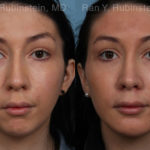 Chin Augmentation Before and After Photos in Montvale, NJ, Patient 20848
