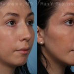 Chin Augmentation Before and After Photos in Montvale, NJ, Patient 20848
