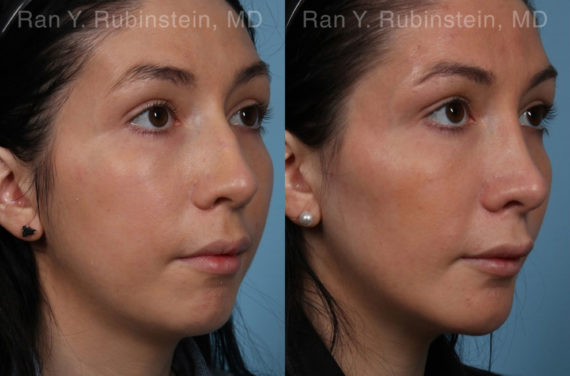 Chin Augmentation Before and After Photos in Montvale, NJ, Patient 20848