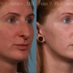 Rhinoplasty Before and After Photos in Montvale, NJ, Patient 21130