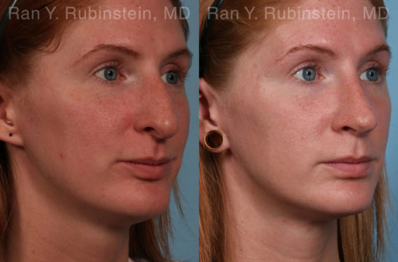 Rhinoplasty Before and After Photos in Montvale, NJ, Patient 21130