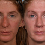 Rhinoplasty Before and After Photos in Montvale, NJ, Patient 21130