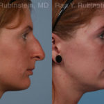 Rhinoplasty Before and After Photos in Montvale, NJ, Patient 21130