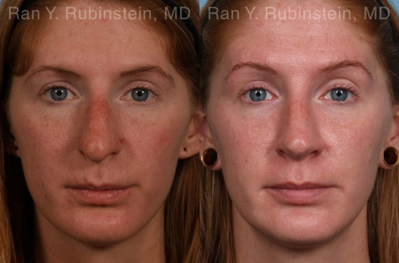Rhinoplasty Before and After Photos in Montvale, NJ, Patient 21130