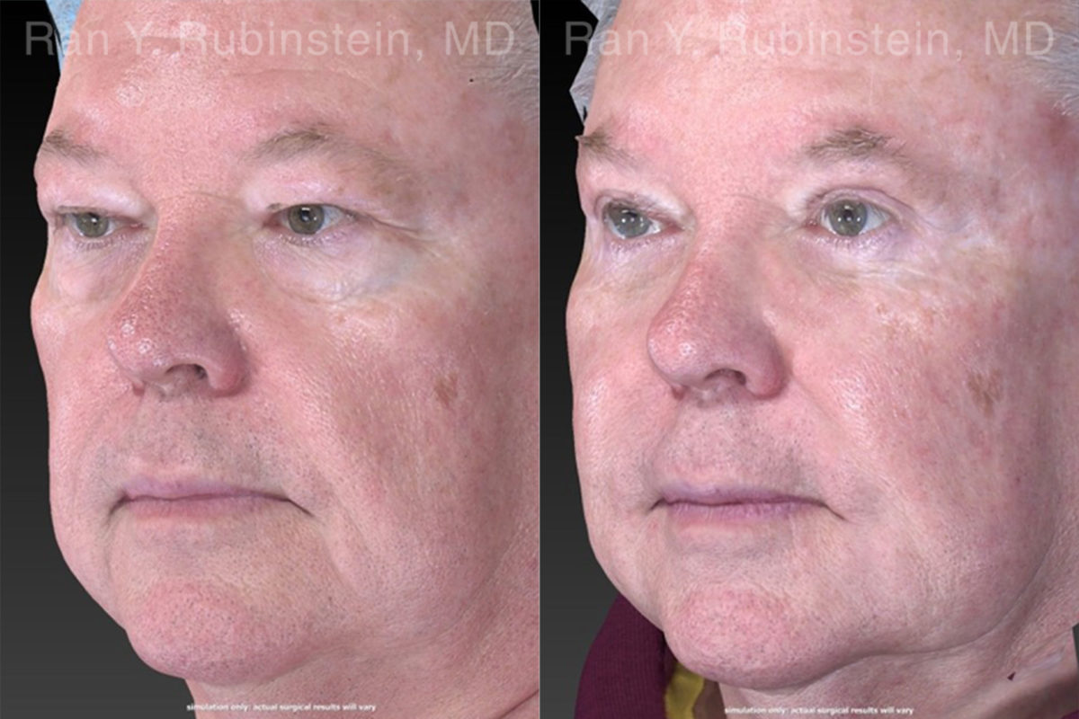 Eyelid Surgery Before and After Photos in Montvale, NJ, Patient 21152