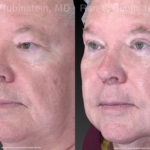 Eyelid Surgery Before and After Photos in Montvale, NJ, Patient 21152