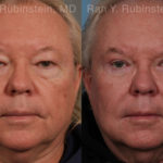 Eyelid Surgery Before and After Photos in Montvale, NJ, Patient 21152