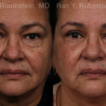 Eyelid Surgery Before and After Photos in Montvale, NJ, Patient 21159