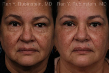 Eyelid Surgery Before and After Photos in Montvale, NJ, Patient 21159