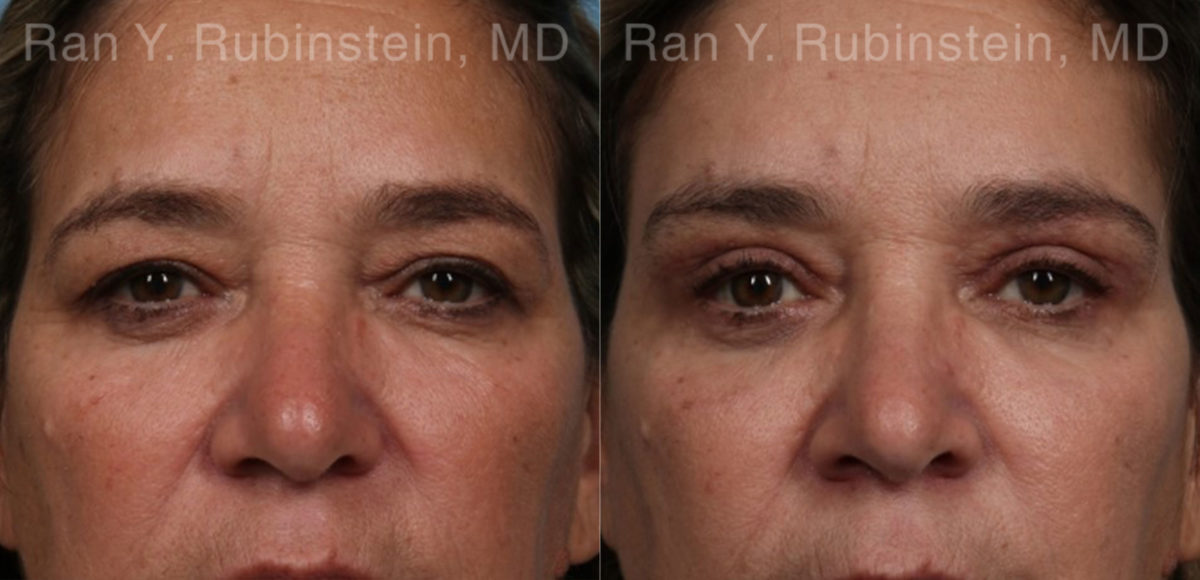 Brow Lift Before and After Photos in Montvale, NJ, Patient 21163