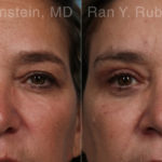 Brow Lift Before and After Photos in Montvale, NJ, Patient 21163