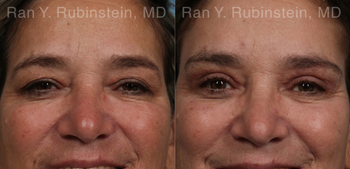 Brow Lift Before and After Photos in Montvale, NJ, Patient 21163