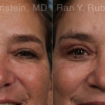 Brow Lift Before and After Photos in Montvale, NJ, Patient 21163