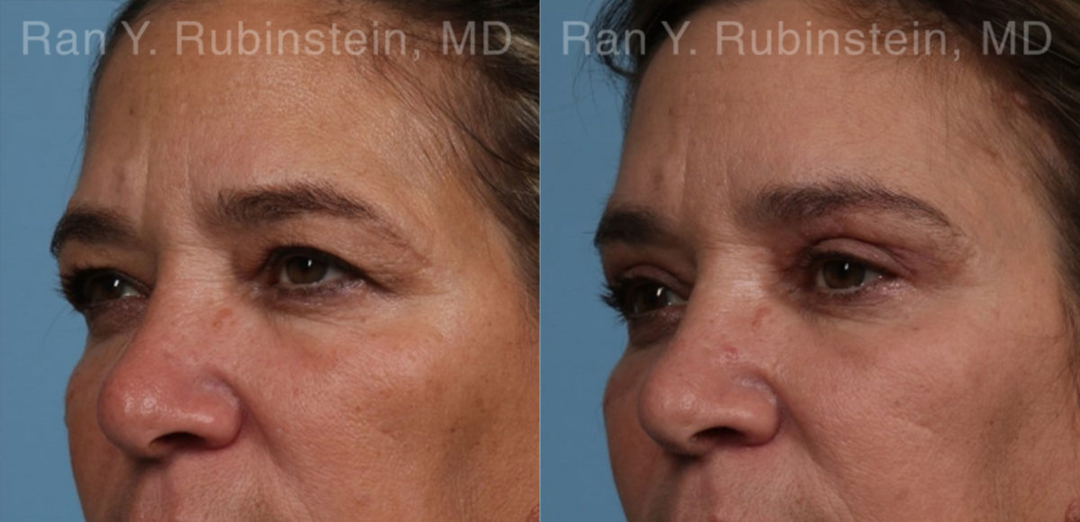 Brow Lift Before and After Photos in Montvale, NJ, Patient 21163