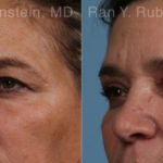 Brow Lift Before and After Photos in Montvale, NJ, Patient 21163