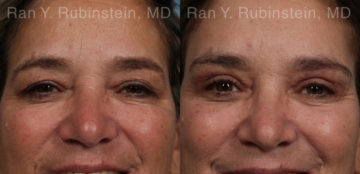 Brow Lift Before and After Photos in Montvale, NJ, Patient 21163