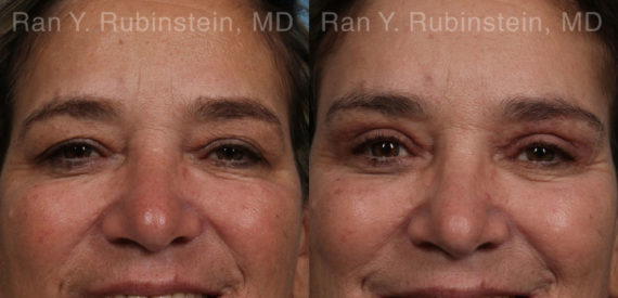 Brow Lift Before and After Photos in Montvale, NJ, Patient 21163