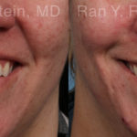 Botox Before and After Photos in Montvale, NJ, Patient 21747