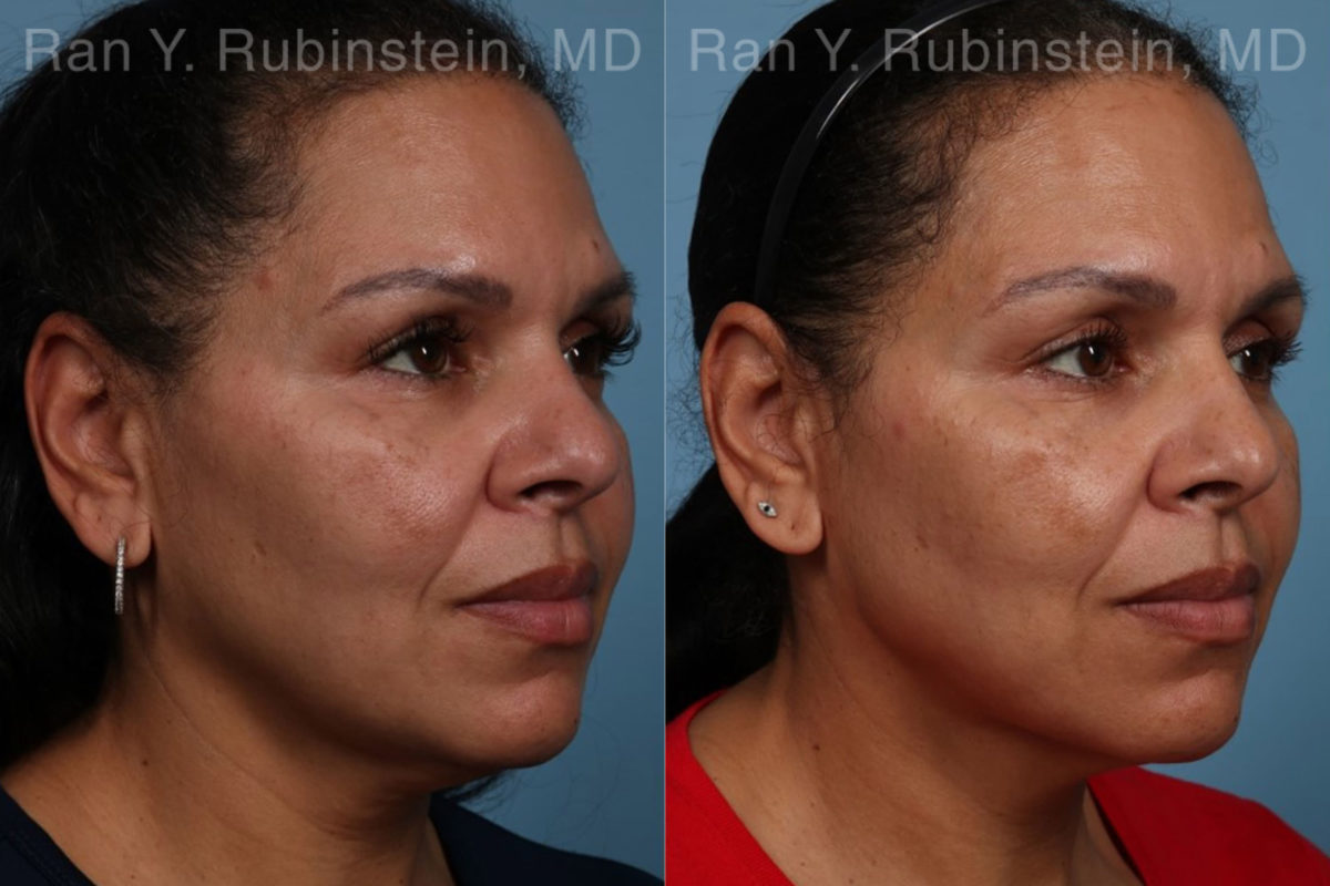 Laser Lift Precision Tx Before and After Photos in Montvale, NJ, Patient 21756