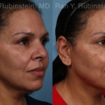 Laser Lift Precision Tx Before and After Photos in Montvale, NJ, Patient 21756