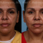 Laser Lift Precision Tx Before and After Photos in Montvale, NJ, Patient 21756