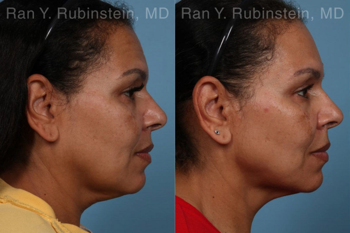 Laser Lift Precision Tx Before and After Photos in Montvale, NJ, Patient 21756
