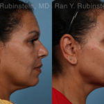 Laser Lift Precision Tx Before and After Photos in Montvale, NJ, Patient 21756