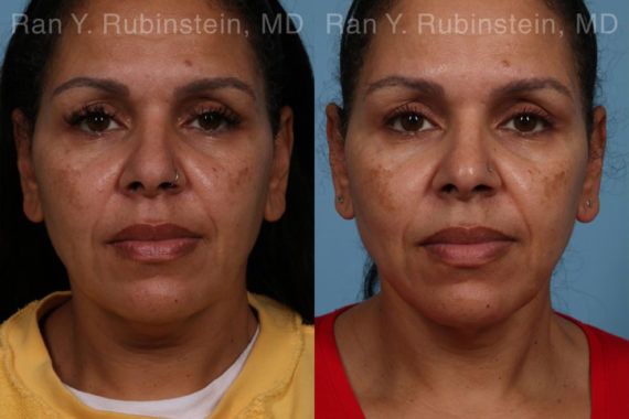 Laser Lift Precision Tx Before and After Photos in Montvale, NJ, Patient 21756