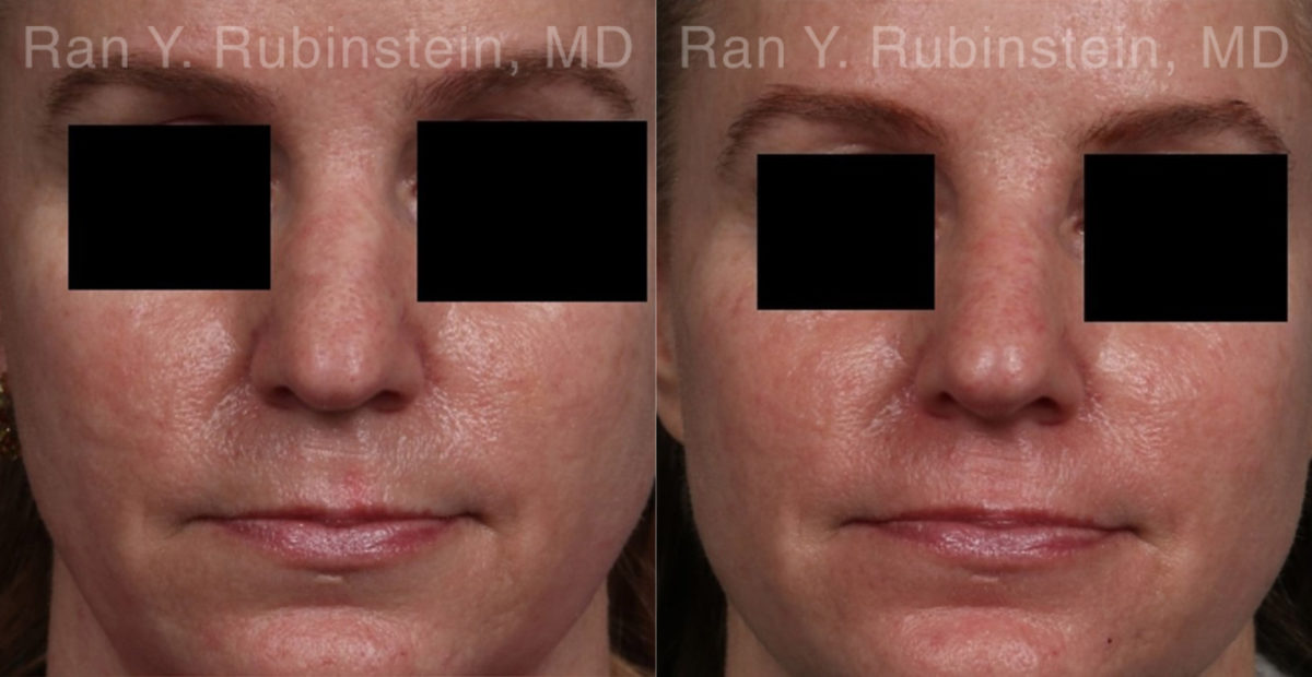 Non-Surgical Rhinoplasty Before and After Photos in Montvale, NJ, Patient 21776