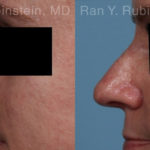 Non-Surgical Rhinoplasty Before and After Photos in Montvale, NJ, Patient 21776
