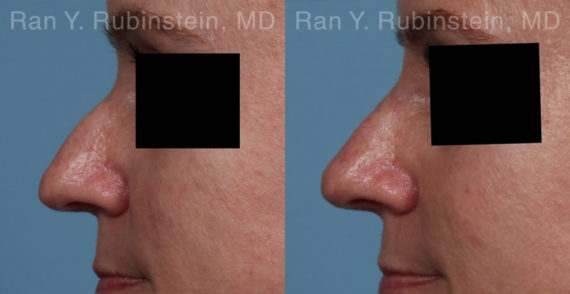 Non-Surgical Rhinoplasty Before and After Photos in Montvale, NJ, Patient 21776