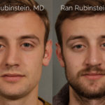 Rhinoplasty Before and After Photos in Montvale, NJ, Patient 21782