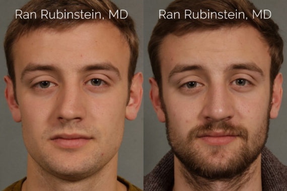 Rhinoplasty Before and After Photos in Montvale, NJ, Patient 21782