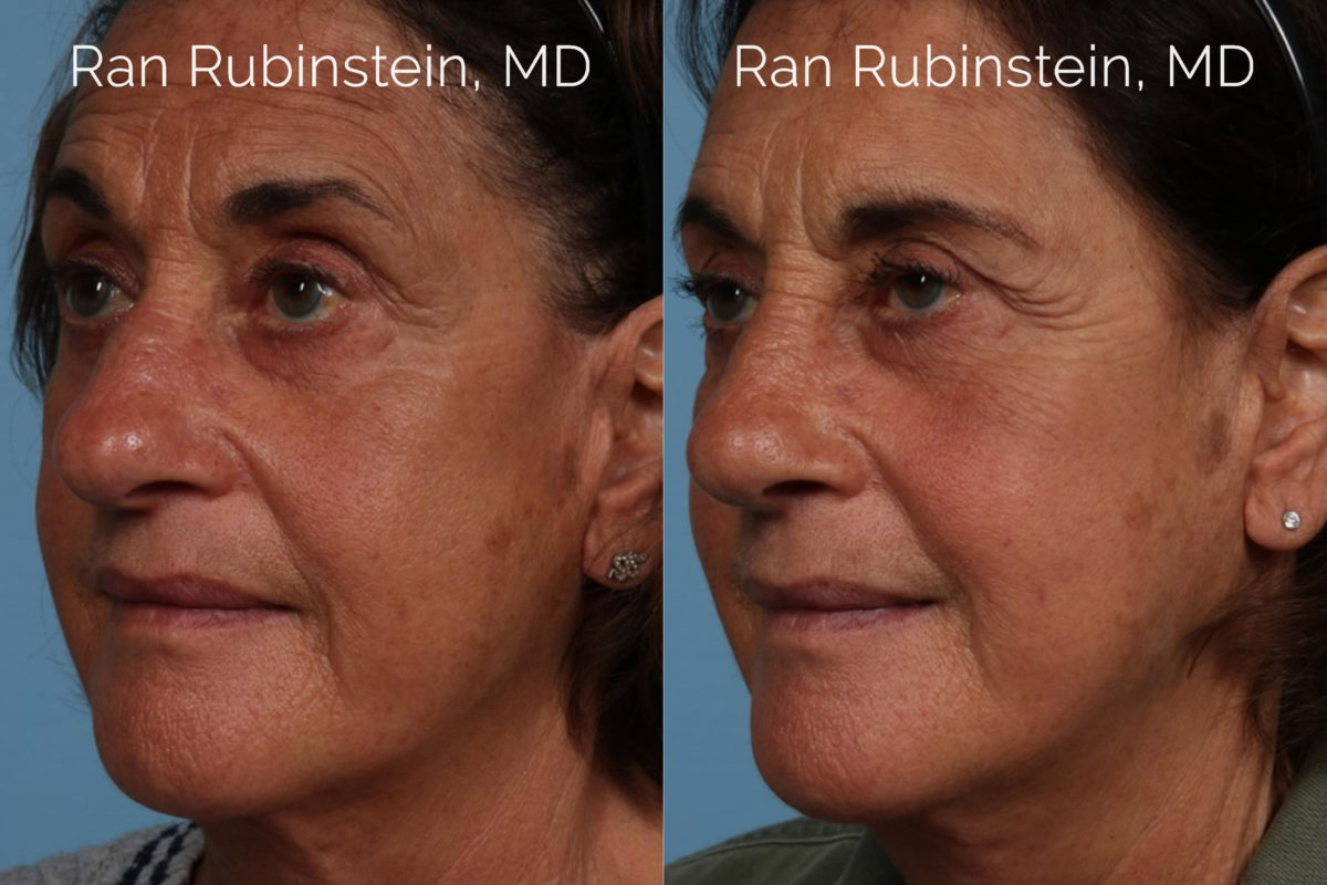 Rhinoplasty Before and After Photos in Montvale, NJ, Patient 21791