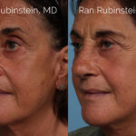 Rhinoplasty Before and After Photos in Montvale, NJ, Patient 21791