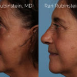 Rhinoplasty Before and After Photos in Montvale, NJ, Patient 21791