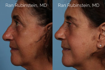Rhinoplasty Before and After Photos in Montvale, NJ, Patient 21791