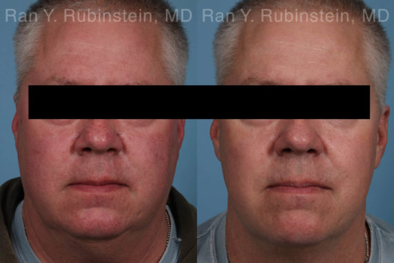 Laser Treatments Before and After Photos in Montvale, NJ, Patient 21864