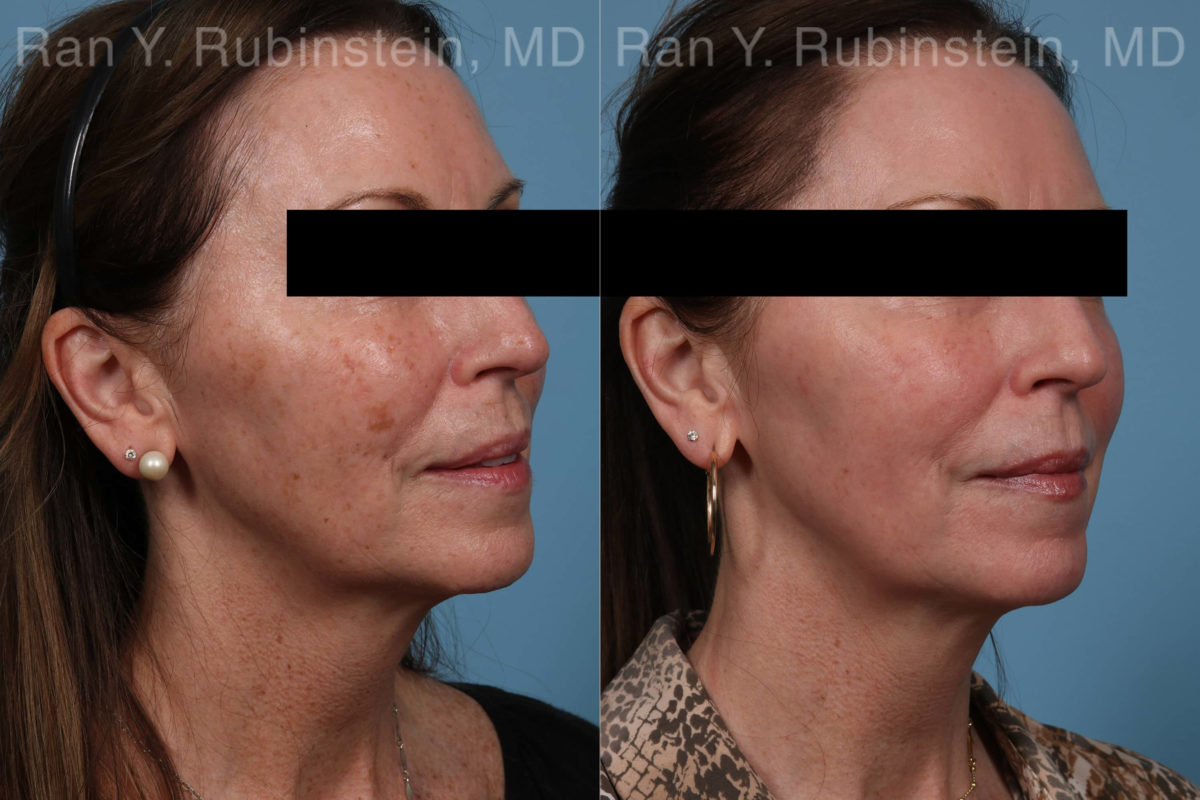 Laser Treatments Before and After Photos in Montvale, NJ, Patient 21869
