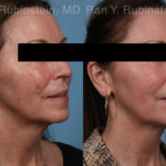 Laser Treatments Before and After Photos in Montvale, NJ, Patient 21869