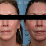 Laser Treatments Before and After Photos in Montvale, NJ, Patient 21869