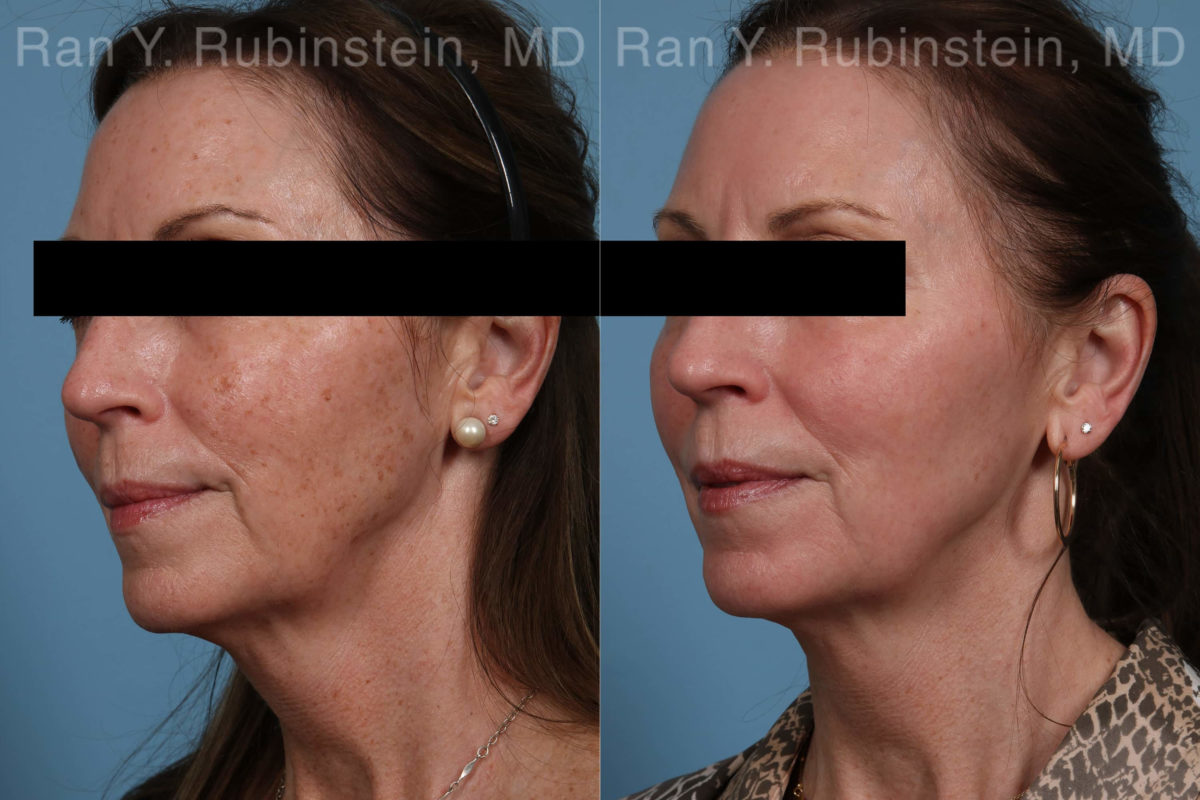 Laser Treatments Before and After Photos in Montvale, NJ, Patient 21869