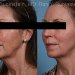 Laser Treatments Before and After Photos in Montvale, NJ, Patient 21869