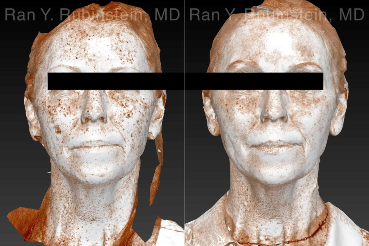 Laser Treatments Before and After Photos in Montvale, NJ, Patient 21869