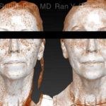 Laser Treatments Before and After Photos in Montvale, NJ, Patient 21869