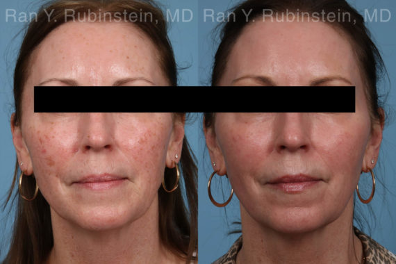 Laser Treatments Before and After Photos in Montvale, NJ, Patient 21869